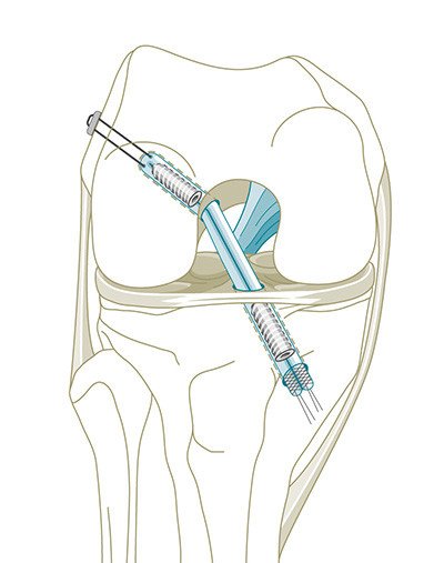 Kreuzbandriss – Kreuzbandruptur | Schulthess Klinik